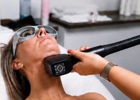 Épilation laser visage — 12 MOIS
